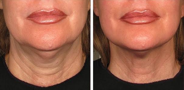 Can You Tighten Sagging Skin Without Surgery?